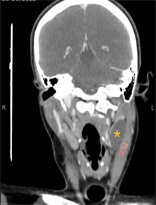 Coronal CT neck scan showing the branchial cleft cyst lying beneath the SCM. Asterisk: branchial cleft cyst.