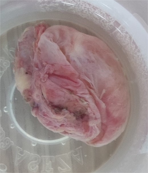 Gross photograph of the excised mass.