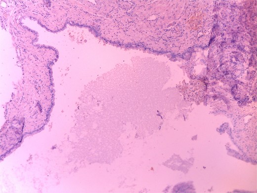 Microscopic histopathological picture showing a cystic structure lined by squamous and respiratory epithelium consistent with a branchial cleft cyst with no features of malignancy.