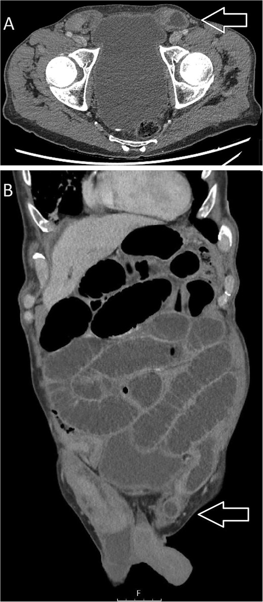 CT images: (A) axial and (B) coronal views suggestive of small bowel obstruction secondary to an obstructed, incarcerated left inguinal hernia. Arrows have been added to the image to mark the site of the left inguinal hernia.