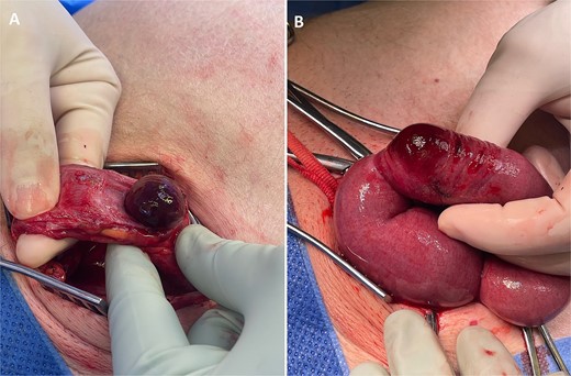 Intra-operative photographs: (A) strangulated small bowel on opening the indirect inguinal hernia sac, and (B) affected small bowel segment once delivered, demonstrating that only the anti-mesenteric portion of small bowel was entrapped within the hernia—findings consistent with a Richter’s hernia.
