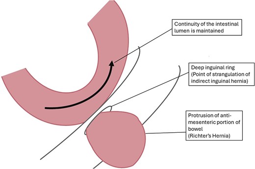 Labelled diagram of strangulated indirect inguinal Richter’s hernia. Created by CR Smith.
