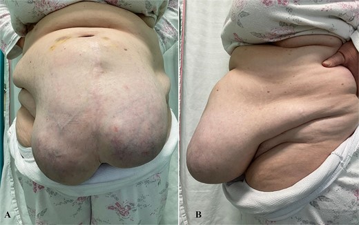 Female patient with M4 W3 hernia.
