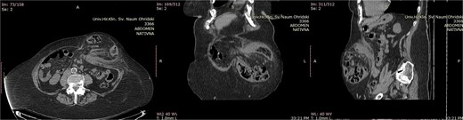 Abdominal computerized tomography scan of a patient with M3W2 incarcerated incisional hernia. The incarcerated loop of the transverse colon is visible in the hernia sac (A-axial scan, B-coronal scan, C-sagittal scan).