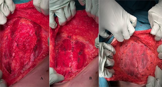 Intraoperative photos. (A) Incised anterior rectus sheet on both sides. (B) The overlapped rectus sheet sutured, “new linea alba” was created and the rectus abdomins muscles approximated. (C) Polypropylene mesh implanted and fixed onlay.
