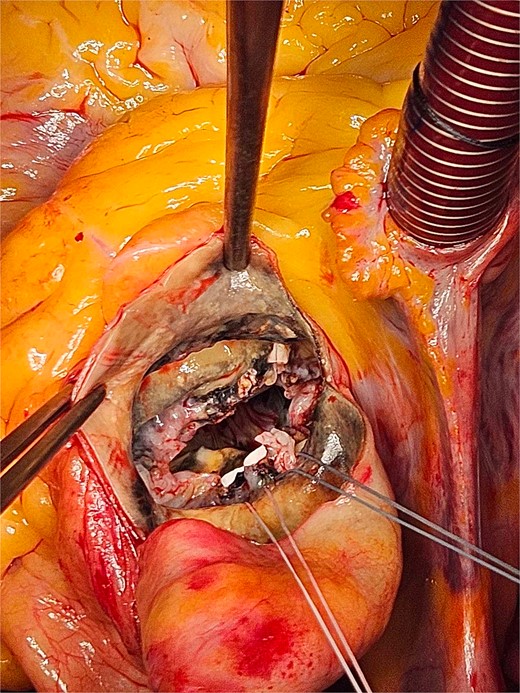 The patchy ochronotic discolouration can be visualized along the aortic root walls and extending below towards the mitral valve.