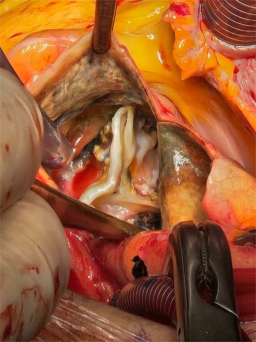 The patchy ochronotic discolouration can be visualized along the aortic root walls, and along the aortic valve leaflets, being more prominent along areas of heavy calcification.