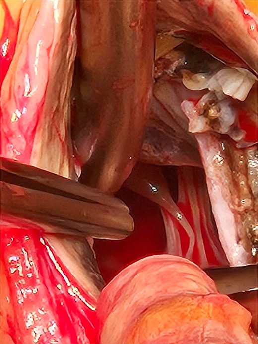 The extent of the ochronotic uptake can be seen extending to the level of the papillary muscles.