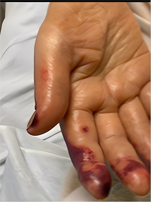 Digital ischaemia on the right hand.