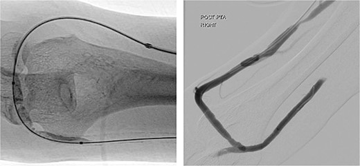 Angioplasty of the arteriovenous fistula 2 days prior to clinical presentation.