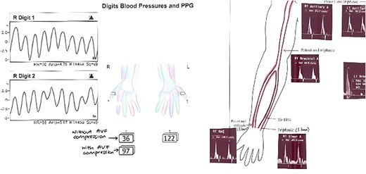 Investigations confirming dialysis-associated steal syndrome (DASS).
