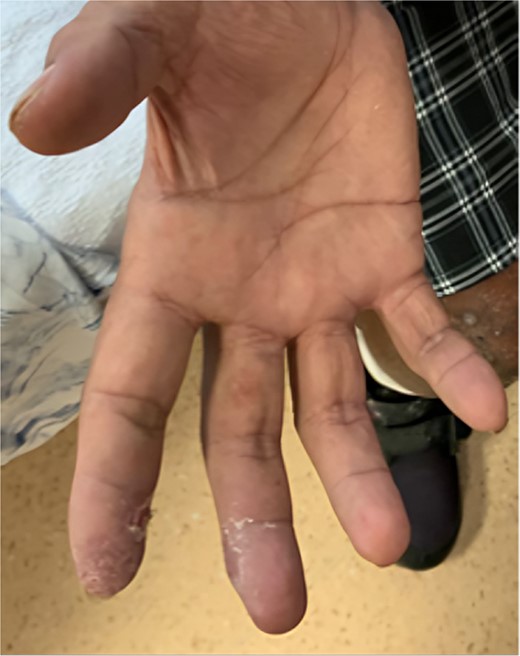 Resolution of ischaemic symptoms after the RUDI procedure.