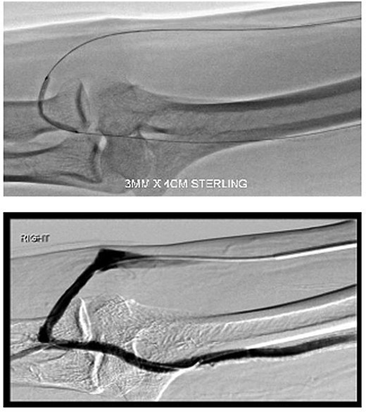 Angioplasty of the RUDI conduit vessel.