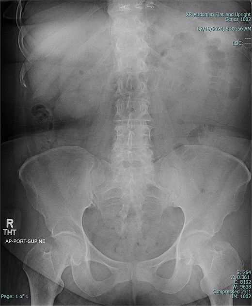 Preoperative X-ray of abdomen, demonstrating small bowel obstruction.