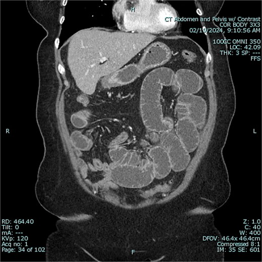 Preoperative CT of abdomen in coronal view, demonstrating small bowel obstruction.