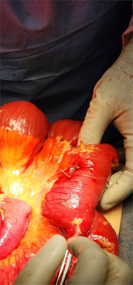 Intraoperative photo of segment of ileum, demonstrating area of perforation.