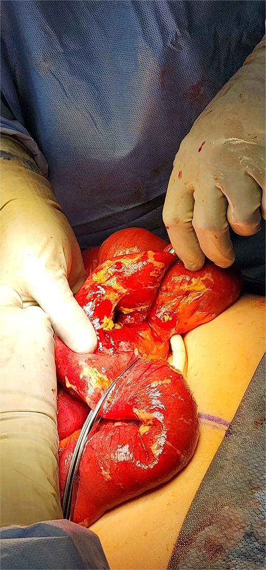 Intraoperative photo of segment of jejunum, demonstrating area of perforation.