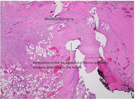 Histologic section of intestinal perforation site that is inked black with H&E stain, suggesting a pressure-related injury.
