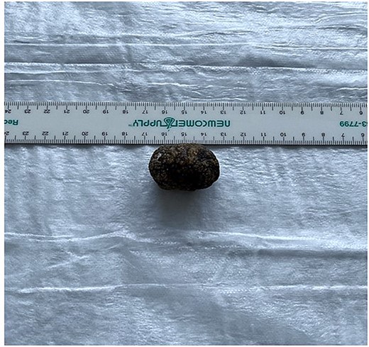 Gross examination of the gallstone.