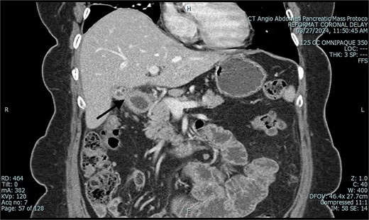 Postoperative CT of abdomen in coronal view, demonstrating suspected cholecystoduodenal fistula.