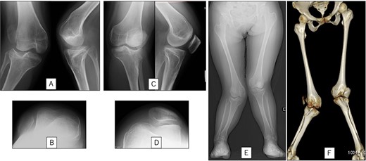 Preoperative radiography and computed tomography: (A) anteroposterior and lateral views of the right knee, (B) skyline view of the right knee, (C) anteroposterior and lateral views of the left knee, (D) skyline view of the left knee, (E) standing anteroposterior view, and (F) 3D image of the entire lower limb.