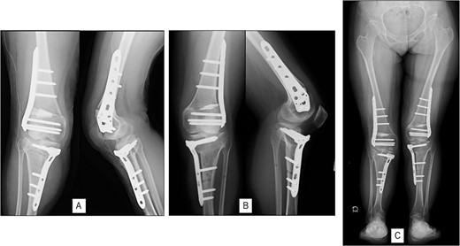 Postoperative radiography: (A) immediate postoperative radiograph of the right knee, (B) immediate postoperative radiograph of the left knee, (C) the entire lower limbs at 2 months after left knee surgery. Mild valgus deformity of the lower limbs persisted.