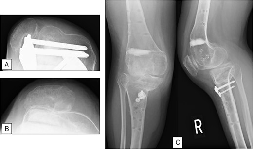 Radiography after right patellar re-dislocation and repair surgery: (A) the patella is eroded owing to contact with the femoral plate. (B) Skyline view after patellar repair surgery. (C) Anteroposterior and lateral view after patellar repair surgery.