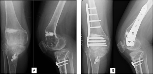 Radiography after fracture at the osteotomy of the right femur. (A) anteroposterior and lateral view immediately after fracture. (B) After open reduction and internal fixation.