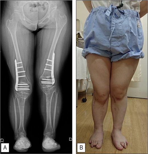 At the final follow-up 10 years after the initial surgery. (A) Standing anteroposterior view. Although mild valgus deformity of the lower limbs remained, no recurrence occurred except for that experienced immediately after surgery. (B) Photograph of the entire lower legs.