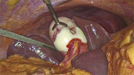 Intraoperative finding of the gallbladder.