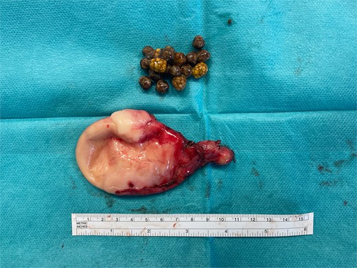 Removed gallbladder with calculi.