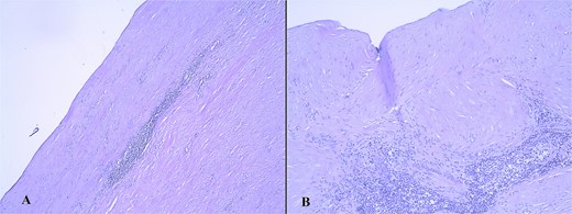 Microscopic finding of the gallbladder wall with hyalinized gallbladder wall, lymphocyte infiltrates, and absence of mucosa, hematoxylin/eosin stain (A, magnification ×5; B, magnification ×10).