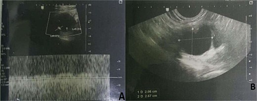 Doppler ultrasound showing left inguinal cystic mass in the femoral sheath compressing the CFV, with no evidence of DVT.