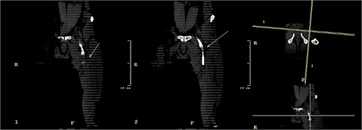 CT Venography with a possible left common femoral vein adventitial cystic disease.