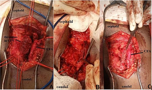 Intraoperative findings: (A) common femoral vein after longitudinal venotomy and thrombus was exposed; (B) the common femoral vein, pointed by forceps, after thrombus had been evacuated; (C) common femoral vein pointed by forceps after completion of venoraphy. CFA, Common Femoral Artery; CFV, Common Femoral Vein.