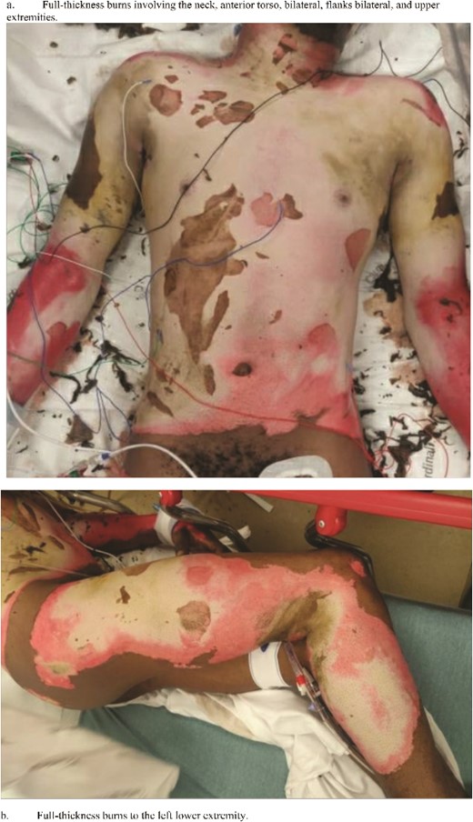 Status-post superficial debridement of burns was calculated to be 49% of TBSA. (a) Full-thickness burns involving the neck, anterior torso, bilateral, flanks bilateral, and upper extremities. (b) Full-thickness burns to the left lower extremity.