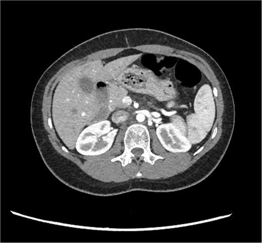 CT pancreas demonstrating absent body and tail of pancreas in axial view.