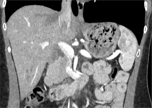 CT pancreas demonstrating absent body and tail of pancreas in coronal view.