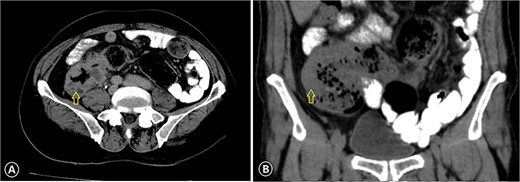 Ascending colon cancer. The CT image with IV contrast revealed a markedly thickened colonic wall (arrow) with pericolonic inflammation: (A) axial view CT scan and (B) coronal view CT scan.