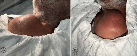 A 68-year-old male admitted for a sternal lump that developed within a few months: (A) lateral view and (B) anterior view.