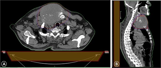 A CT scan with intravenous contrast that showed a sternal tumor of 11 by 12 cm: (A) transversal plane and (B) sagittal plane.