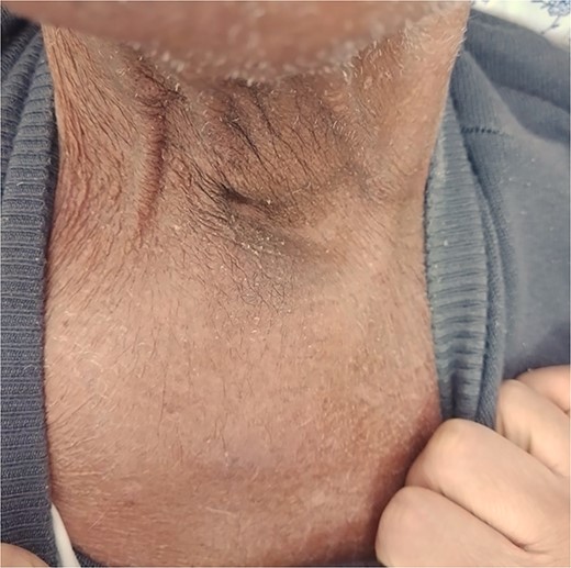 Significant clinical resolution of the mass size post radiation therapy treatment.