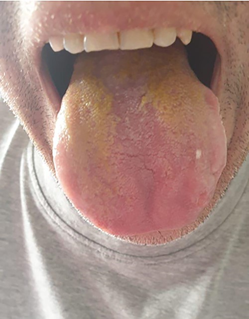 Yellowish pigmentation of the patient’s tongue suggestive of biliptysis.