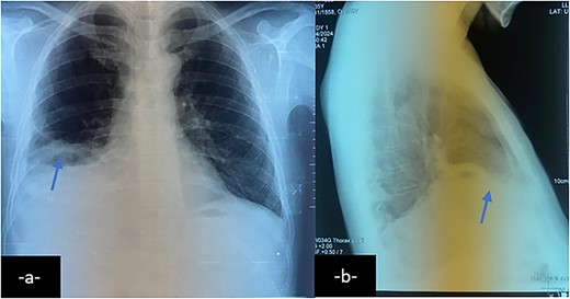 Chest X-ray on postero-anterior (a) and lateral views shows right basal atelectasis of the lung, right pleural effusion and sub phrenic collection with air-fluid level (arrow).