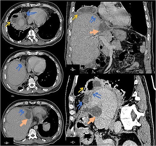 Abdominal CT scan in axial (a), coronal (b), and sagittal (c) reconstruction showing a biliary collection (large arrow) in the left hepatic lobe communicating with a subphenic and pleural collections with possible connexion with lower right airways (arrow) via a fistulary tract (double arrow).