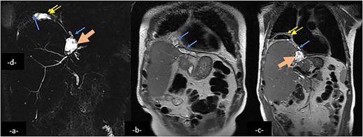 Magnetic resonance cholangio pancreatography (MRCP) in Radial T2 SSFSE sequence and coronal T2 showing a collection (large arrow) in the left hepatic lobe, subphrenic collection (arrow) and right pleural collection (double arrow) containing air and communicating with airways.