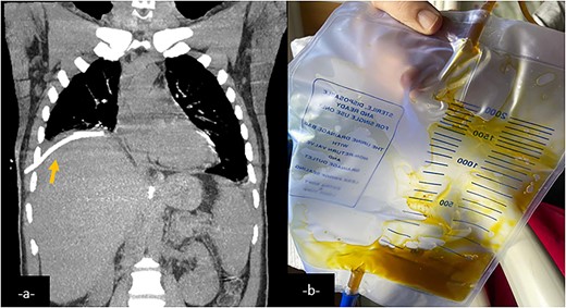 Coronal CT-scan reconstruction after an external drainage of the right pulmonary collection showing a decrease in size of it (a). External drainage finds a brownish fluid consistent with bile (b).