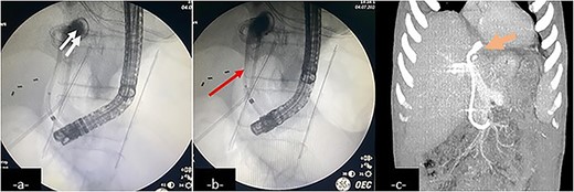 An endoscopic retrograde cholangiopancreatography (ERCP) showing contrast leakage from left-sided bile duct (a, double arrow) with duodenal fistula communicating with the biloma, drained by an inserted stent (b, arrow). Follow-up coronal CT-scan reconstruction after ERCP shows the internal drainage (c, large arrow).