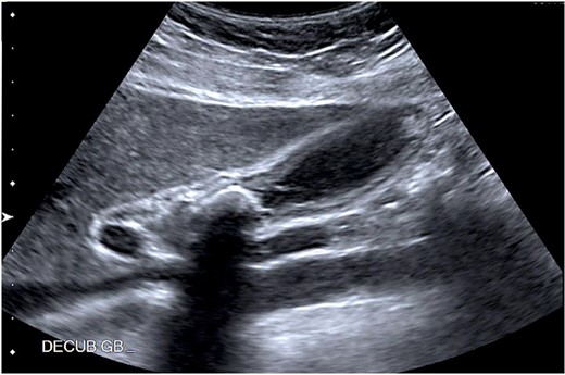 Abdominal ultrasound showing a 2.1 cm calcified gallstone in the gallbladder neck, and a thickened wall.