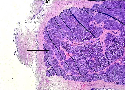 H & E stain 20×: Ectopic pancreatic parenchyma, composed of ductal and acinar components (black arrow).